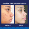 PanOxyl Acne Foaming Wash With Benzoyl Peroxide 10% - 156g